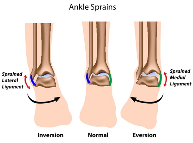 The 5 Most Common Netball Injuries and How to Prevent Them